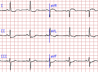 Left ventricular hypertrophy by voltage (R wave 12-13 mm in aVL) plus left atrial abnormality (LAA). The QRS axis is somewhat leftward (-7 degrees), but without frank left axis deviation (more negative than -30 degrees) or evidence for left anterior fascicular block (-45 degrees or more negative). Although LVH alone may be associated with ST-T abnormalities (sometimes referred to as a "strain pattern"), like those in lead aVL, the prominent horizontal or downsloping ST depressions in other leads (I, II, aVF, V5, V6).  (C)  2005 BIDMC