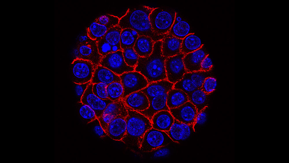 An image of pancreatic cancer cells 