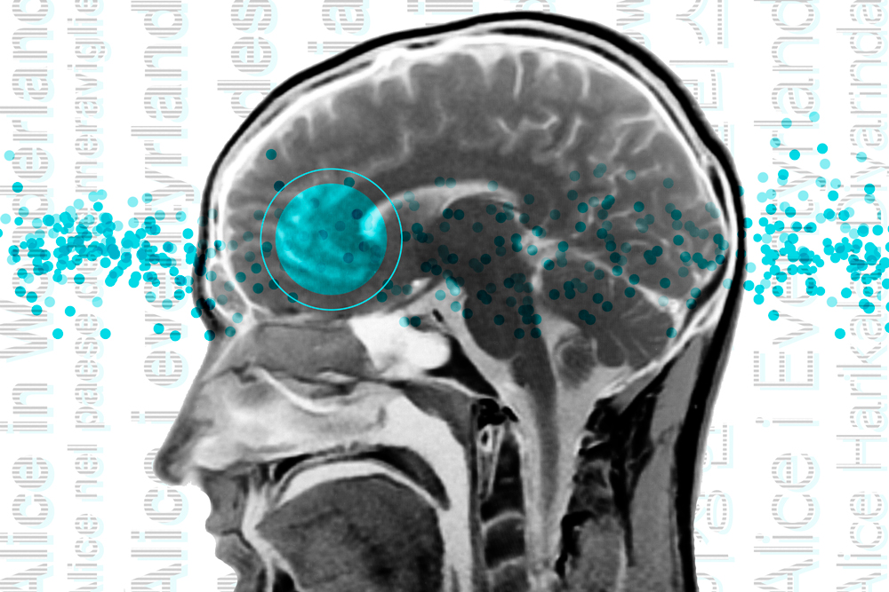 an MRI brain scan with the Broca's Area highlighted in blue over a back ground of Alice in Wonderland words in different languages