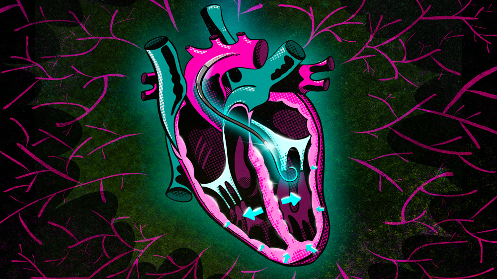 Drawing of a human heart shows a cable with a hook-shaped device inside the heart. Arrows showing movement of the heart.