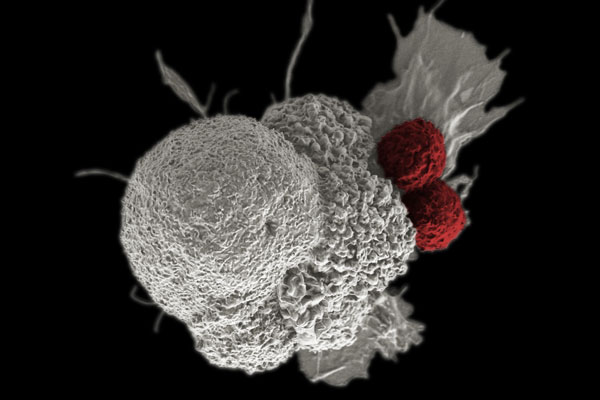 scanning electron micrograph of a cancer cell being attacked by two T cells.