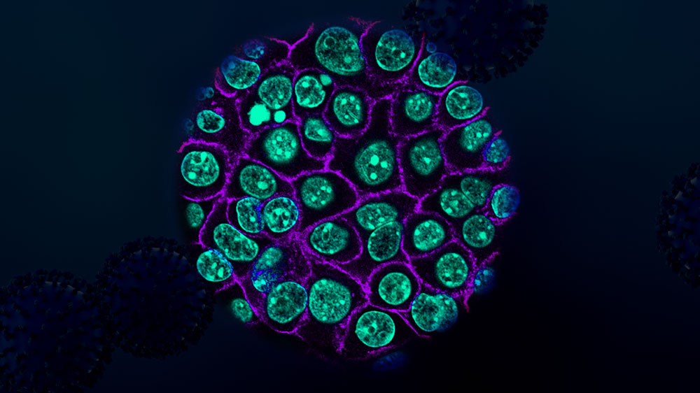 Colorized cancer cells in teal encased in purple membranes