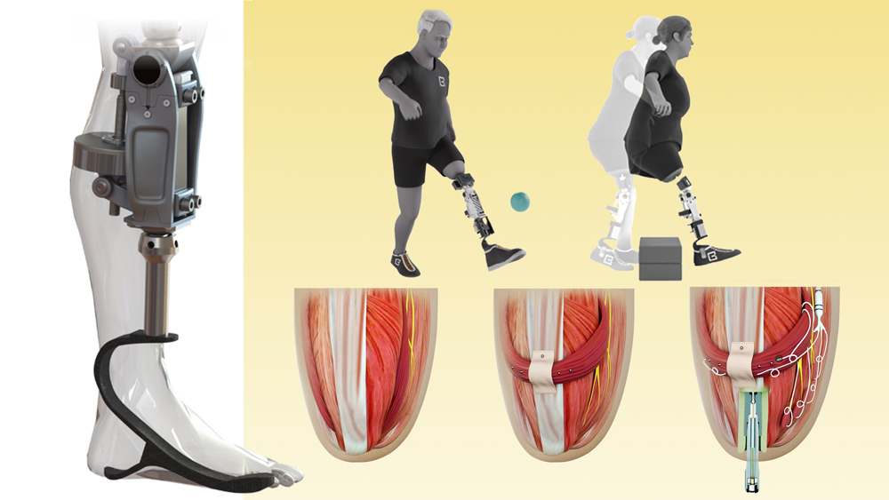 figures of a new prosthetic that starts above the knee