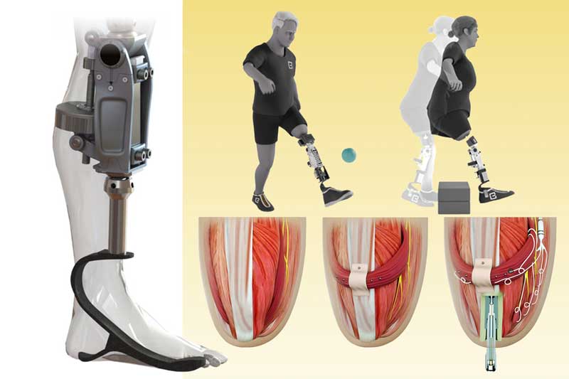 figures showing a new prosthetic that starts above the knee