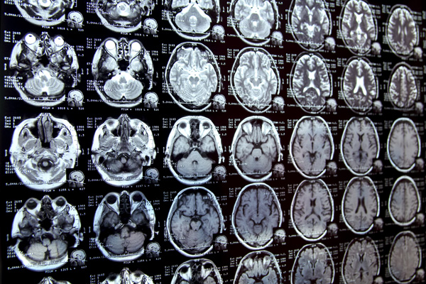 multiple medical scans of the brain