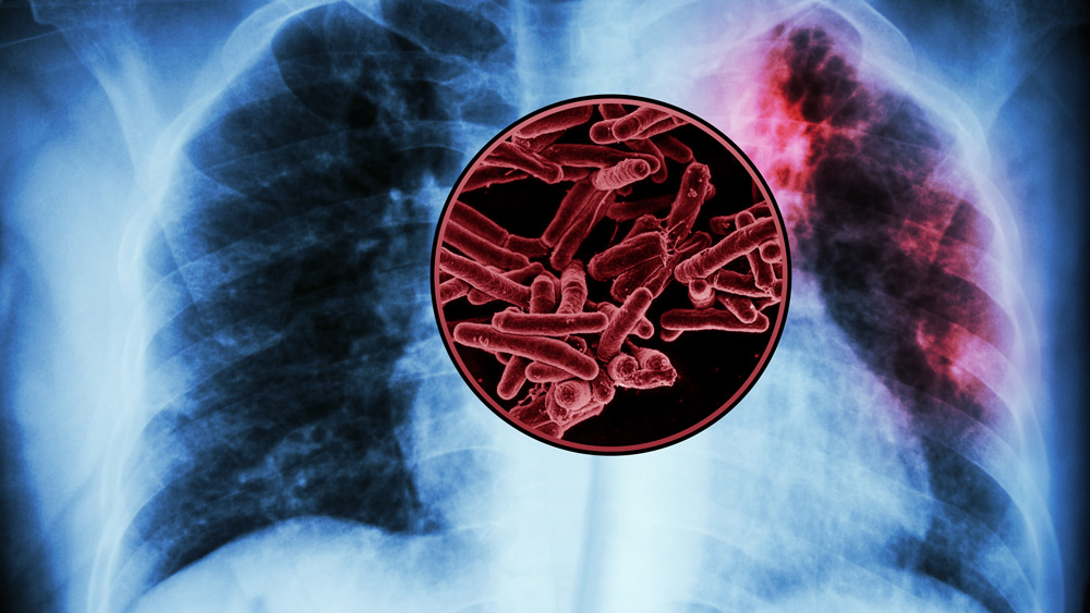 lung xray with overlay of infection