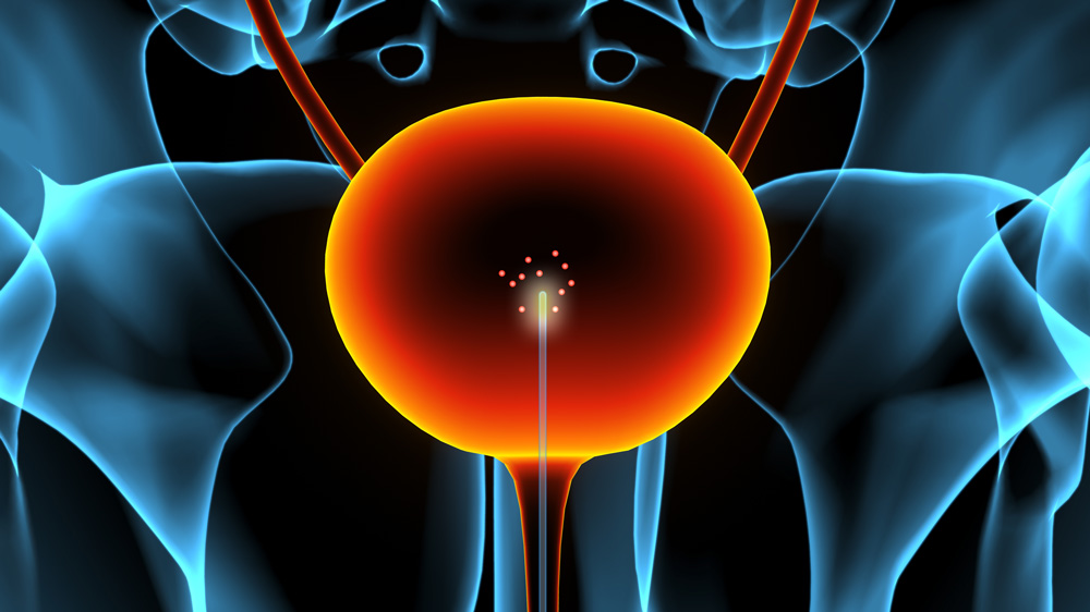 pelvic x-ray illustration with glowing catheter