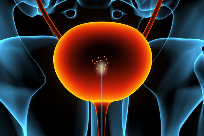 figure of glowing catheter 