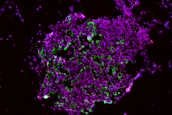 tumor cells in lung